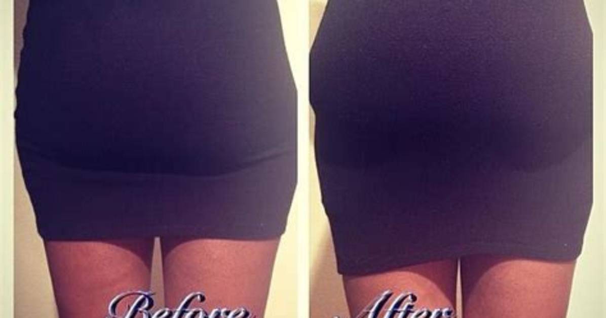 Before and After How Butt Sculpting