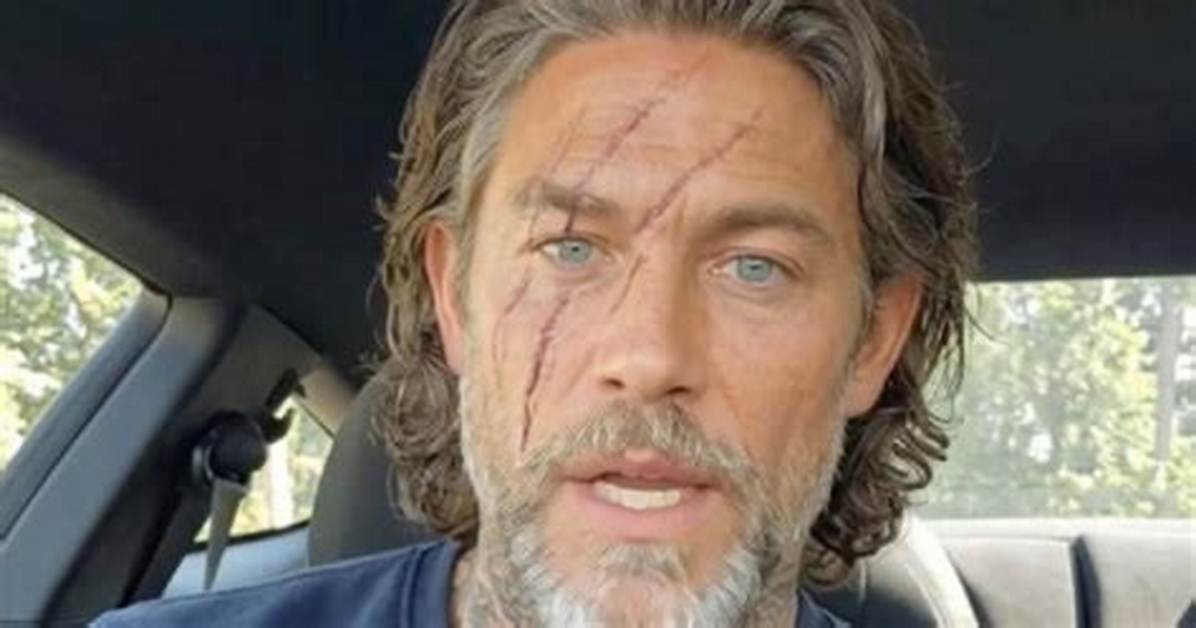 Beyer Hunter Face Scars Reveal the Dramatic Truth Behind The