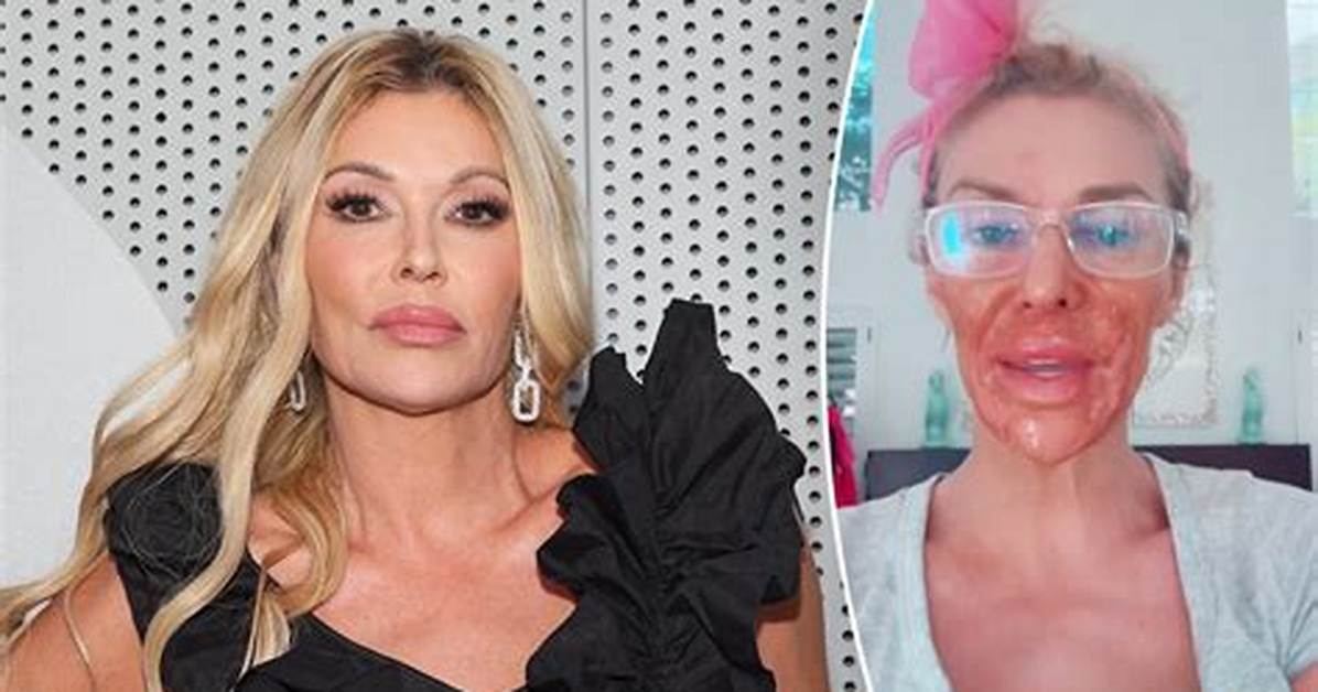 Brandi Glanville Nair Burn Incident Timeline of the Reality Star S Viral