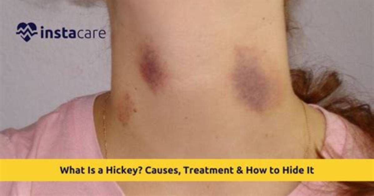 Can a Hickey Actually Cause