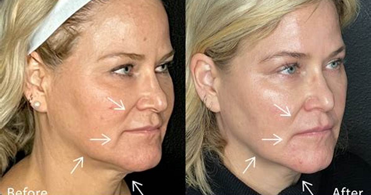 Can Bad Sculptra Results Be Reversed Dermatologists Fact Check The