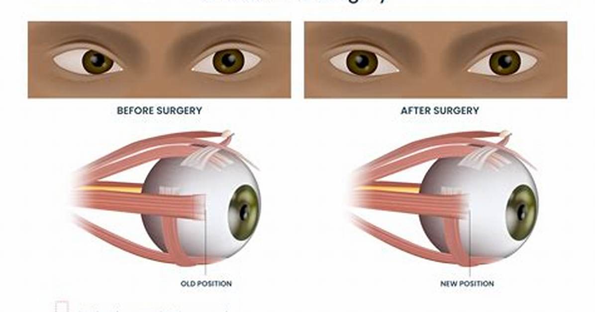 Can Strabismus Surgery Really Fix Cross Eyes in Adults the Truth Behind The