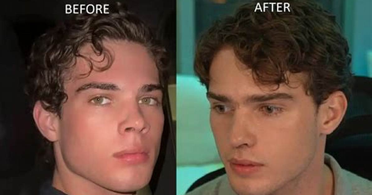 Clavicular Nose Job Before and After Photos Comparing the Streamer S