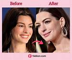 Did Anne Hathaway Get Botox? the Star Breaks Her Silence on 'Distracting' Cosmetic Rumors