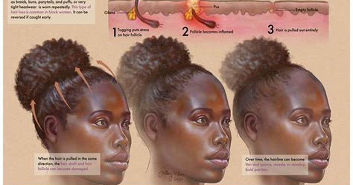 Does a Quick Weave Cause Traction Alopecia Fact Checking Hair