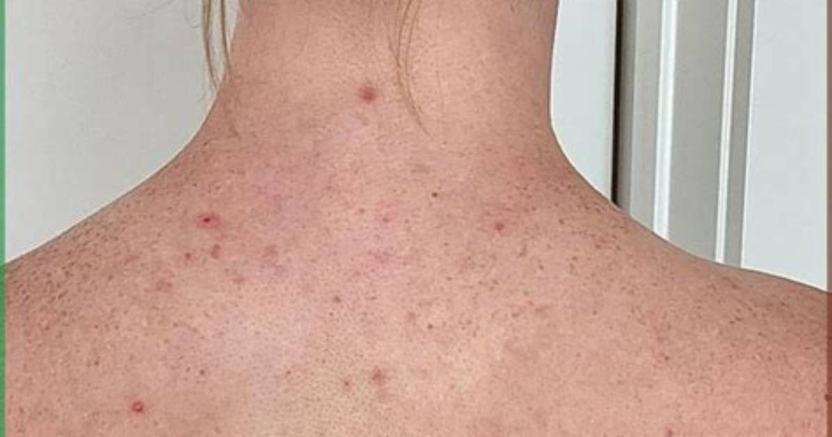Fact Checking Ternscheese S Back Acne Trend Origin And