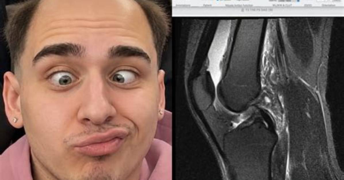 Faze Lacy Knee Injury Breakdown Video Footage and Medical Proof Behind the Acl