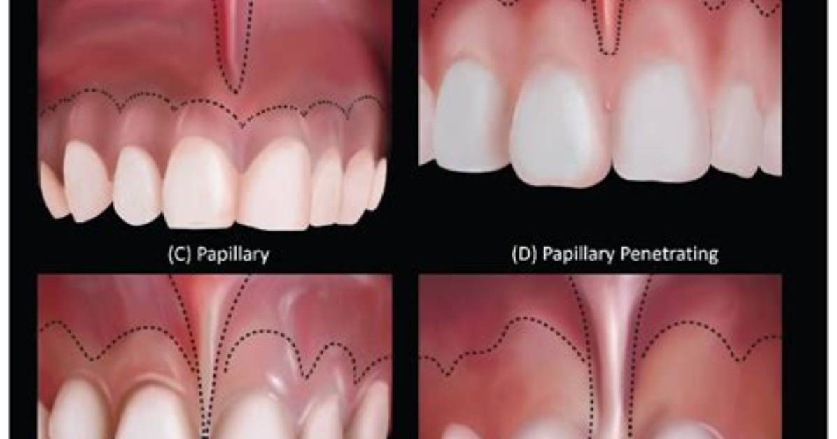 From Single Frenum to Full Ladder the Step by Step Piercing