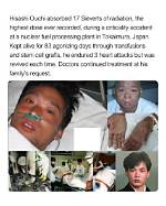 Hisashi Ouchi Medical Photos: a Tragic Case of Radiation Exposure