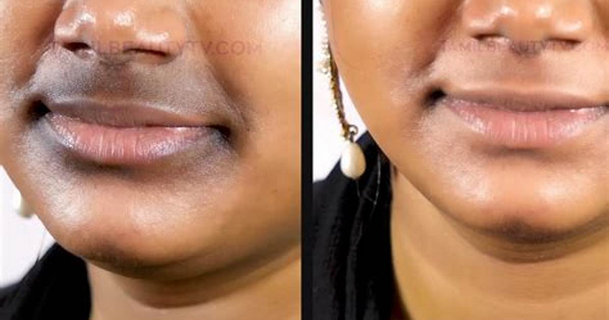 Is a Black Ring Around the Lips Dangerous Dermatologists Debunk Common Myths And
