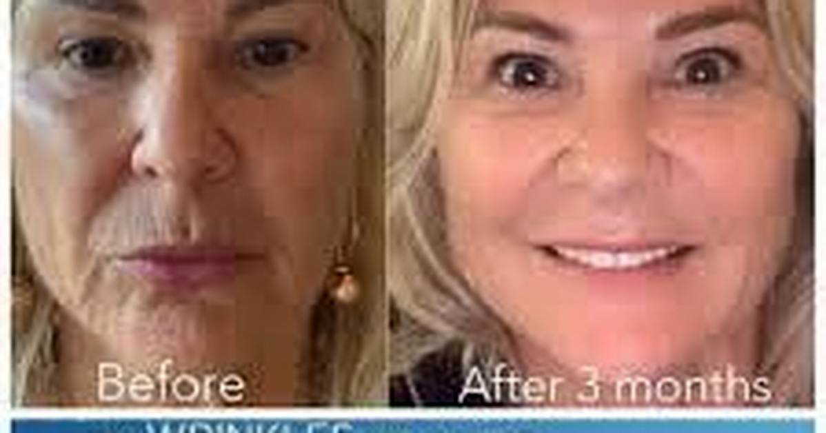 Lifewave X39 Before and After Truth What Real Customers and Clinical