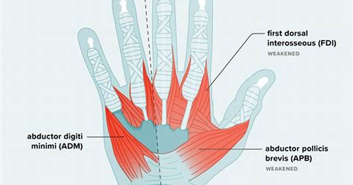 New Clinical Warnings on Hand Weakness When Slipping Grip Signals Serious