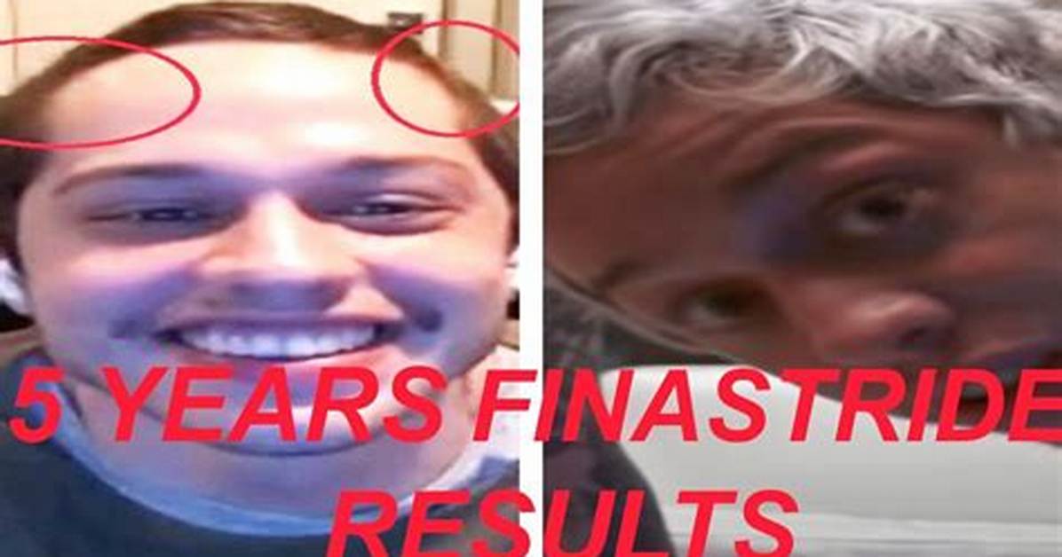 Pete Davidson Finasteride Guide Everything You Need to Know About the Celebrity