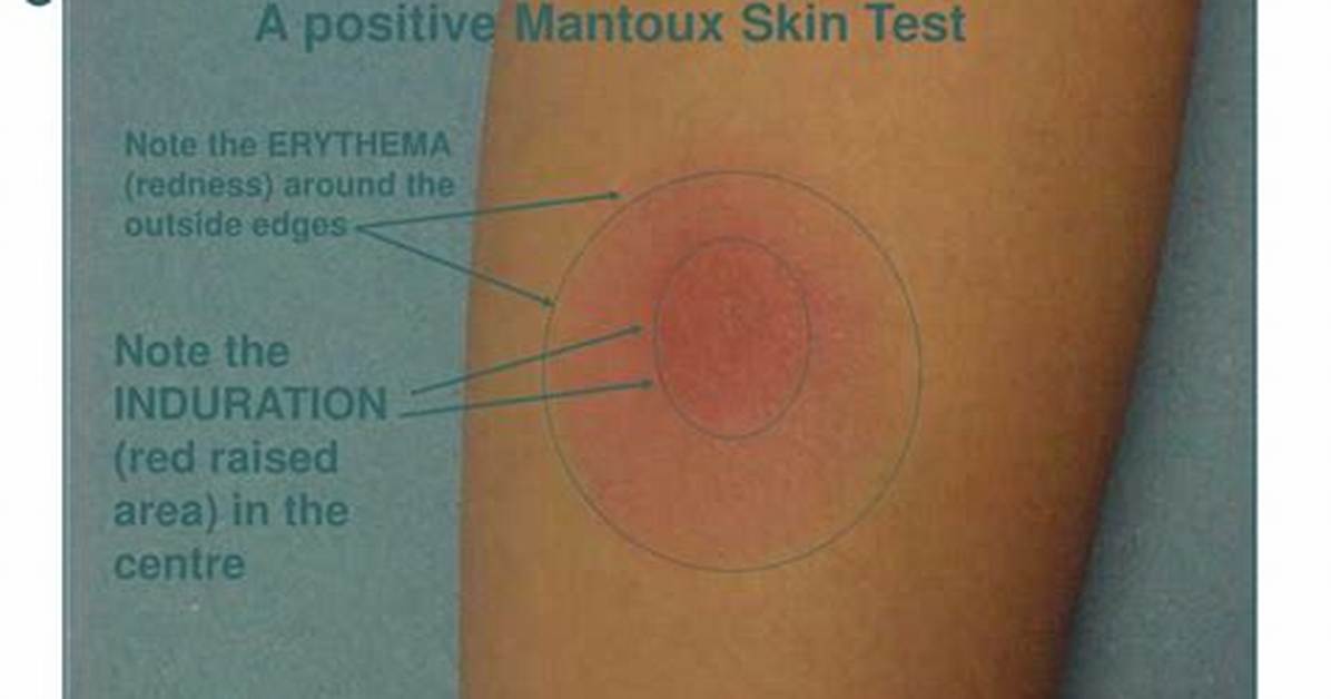 Redness vs Induration the Critical Tb Skin Test Mistake Most