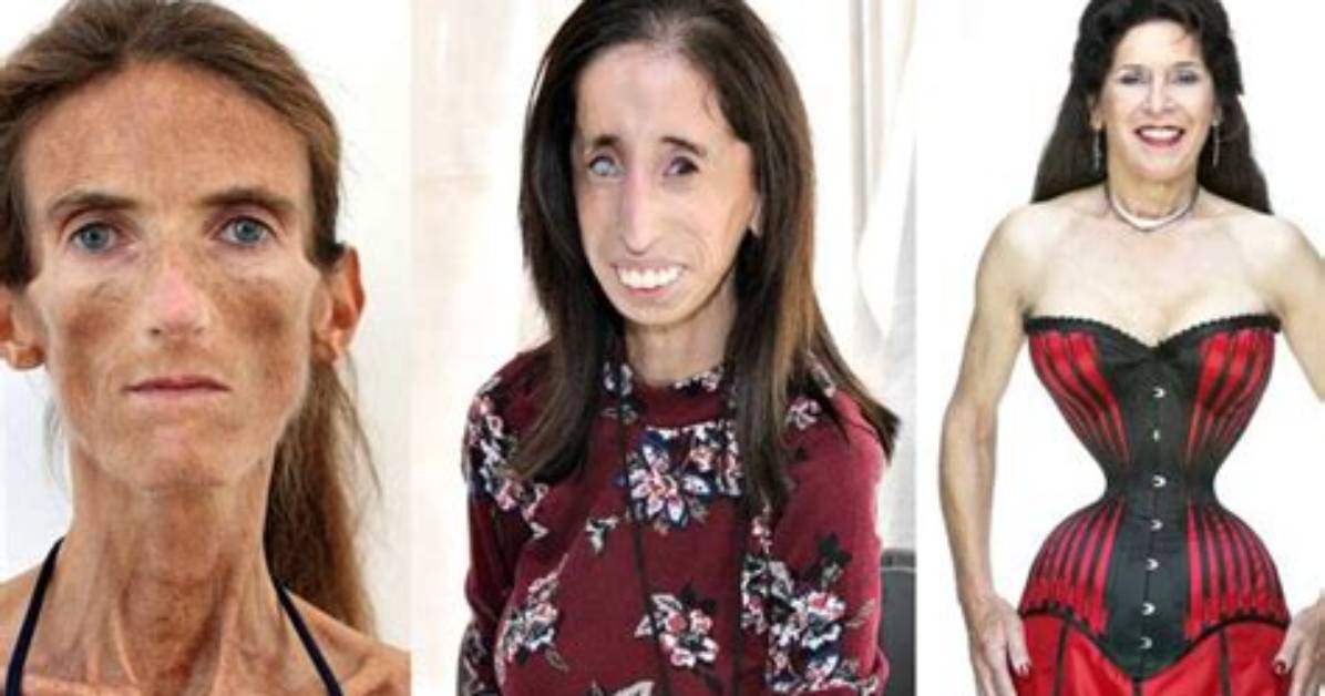 The World S Skinniest Person Separating Viral Internet Myths From