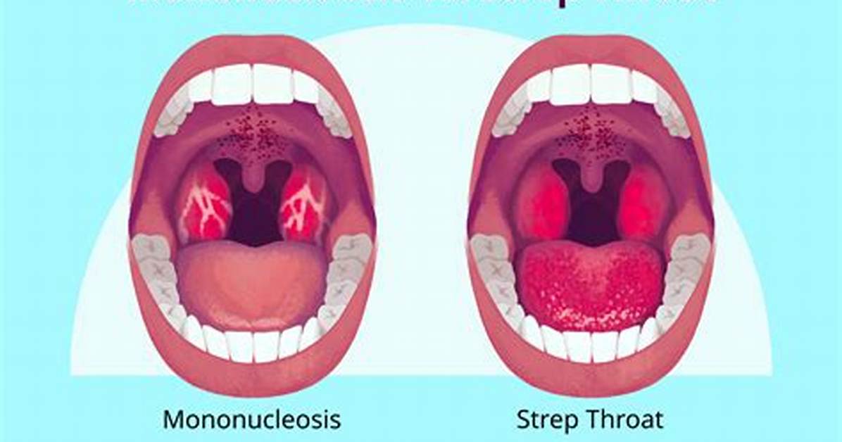 What Does a Mono Throat Look Like Faqs Home Care and Red