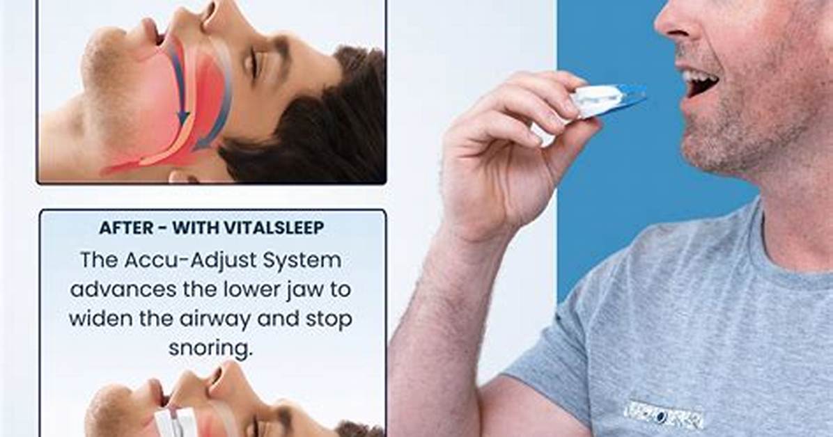 Why over the Counter Snoring Mouthpieces Are Suddenly Replacing Bulky
