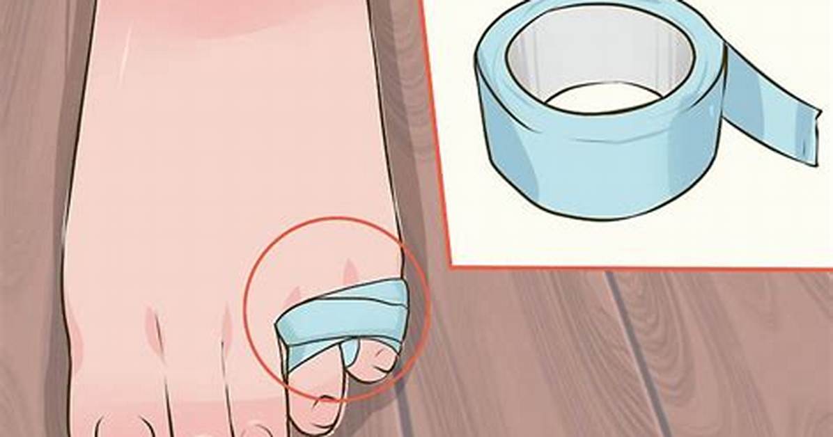 Why Taping Your Broken Pinky Toe Wrong Can Cripple Your