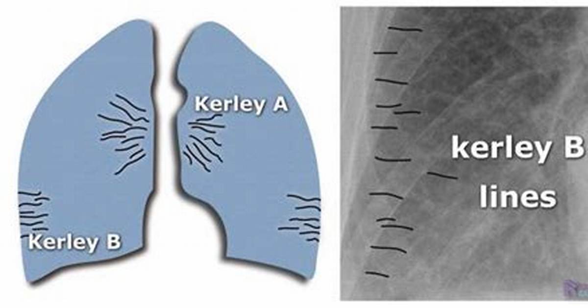 X Ray Kerley Lines vs Lung Ultrasound B Lines Clearing Up